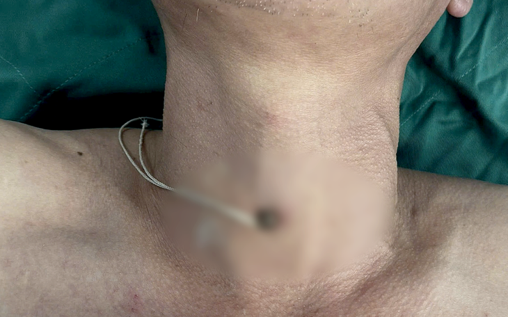 'Cân não' giữ đôi mắt cho bệnh nhân bị hai chiếc đũa dài cắm sâu hai mắt - Ảnh 2.