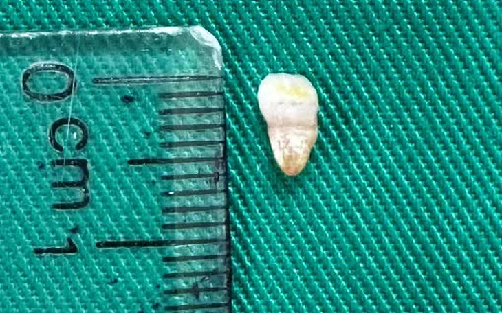 Cứu sống bé trai 6 tuổi mắc dị dạng mạch máu phổi hiếm gặp - Ảnh 3.