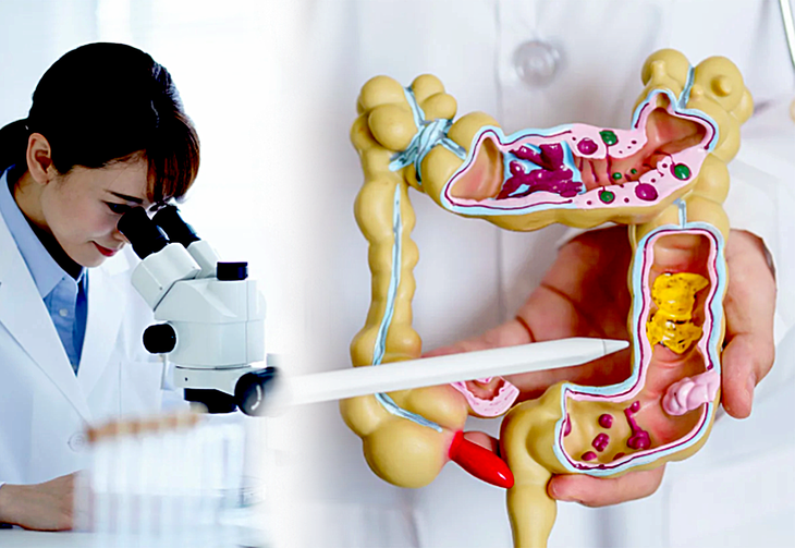 Phương pháp mới phát hiện 90% ca ung thư đại trực tràng không cần nội soi - Ảnh 1.