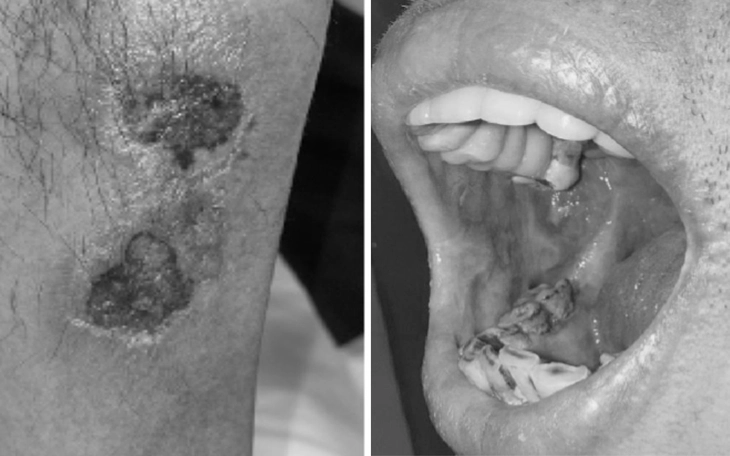 5 bệnh da liễu thường gặp sau mùa mưa lũ và cách xử lý - Ảnh 3.
