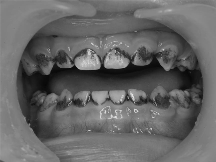 Trẻ có mảng bám đen trên răng sữa có gây mất răng? - Ảnh 1.