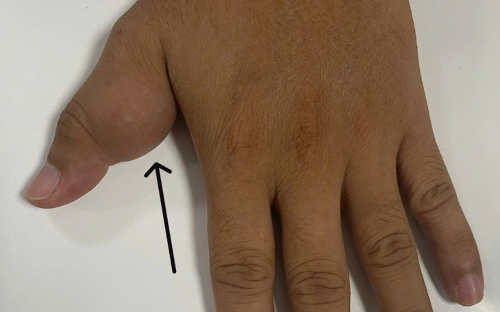 Cứng hàm tưởng uốn ván, người đàn ông khỏe mạnh phát hiện bị nấm đen ăn mòn xương - Ảnh 2.