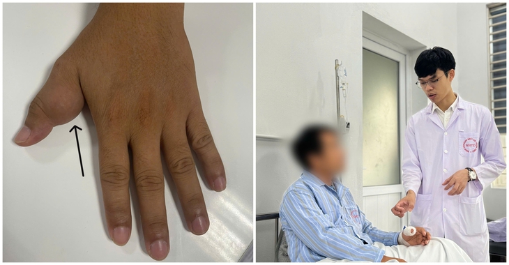 'Khối thịt thừa' 17 năm ở ngón tay gây ăn mòn xương - Ảnh 1. Tưởng 'thịt thừa' ở ngón tay, không ngờ là khối u ăn mòn xương - Ảnh 1.