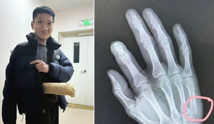 gãy tay - Ảnh 1.