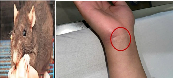 Cảnh báo bệnh lý nguy hiểm khi bị chuột cắn - Ảnh 1. chuột cắn - Ảnh 1.