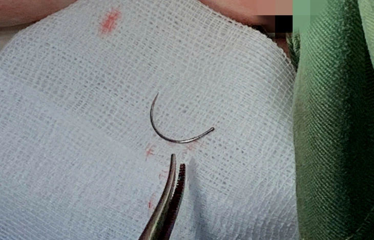 Lấy dị vật kim khâu nằm trong tầng sinh môn nữ bệnh nhân sau 11 năm - Ảnh 1.