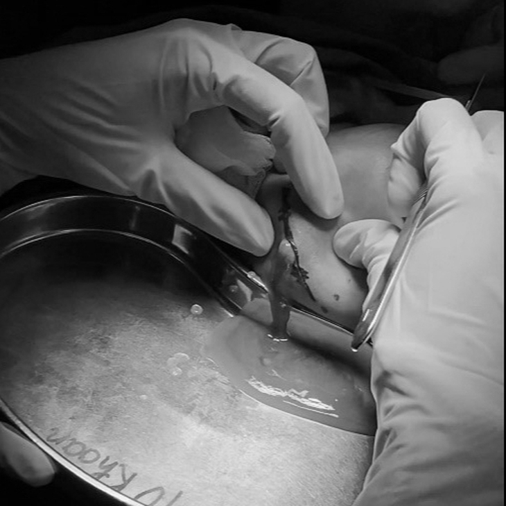 Mông, đùi chảy mủ sau khi tiêm chất làm đầy - Ảnh 1. chất làm đầy - Ảnh 1.