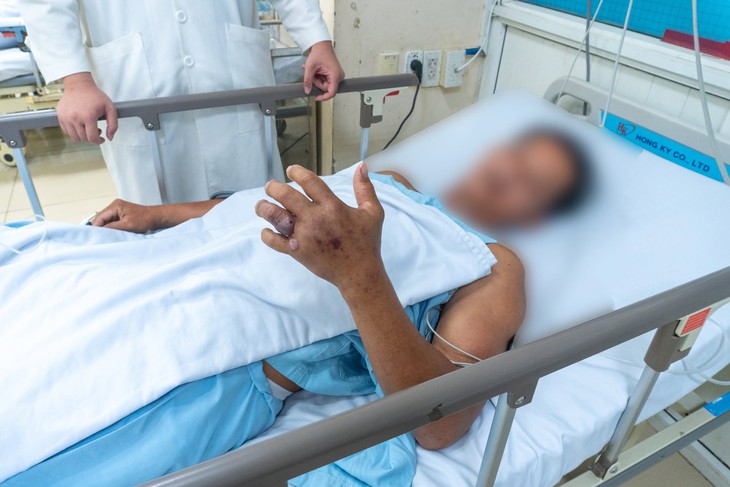 Số ca nhập viện do rắn cắn tăng mạnh, có ca nôn ra máu sau 20 phút cắn - Ảnh 1.