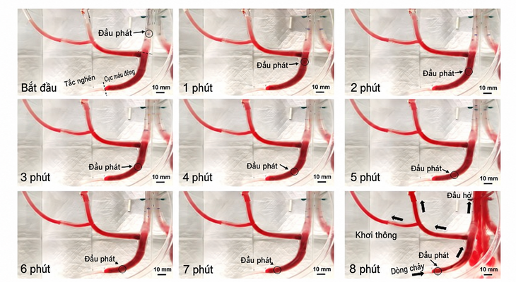 Dùng 'lốc siêu âm' khơi thông cục máu đông gần 8 cm trong 8 phút - Ảnh 2.