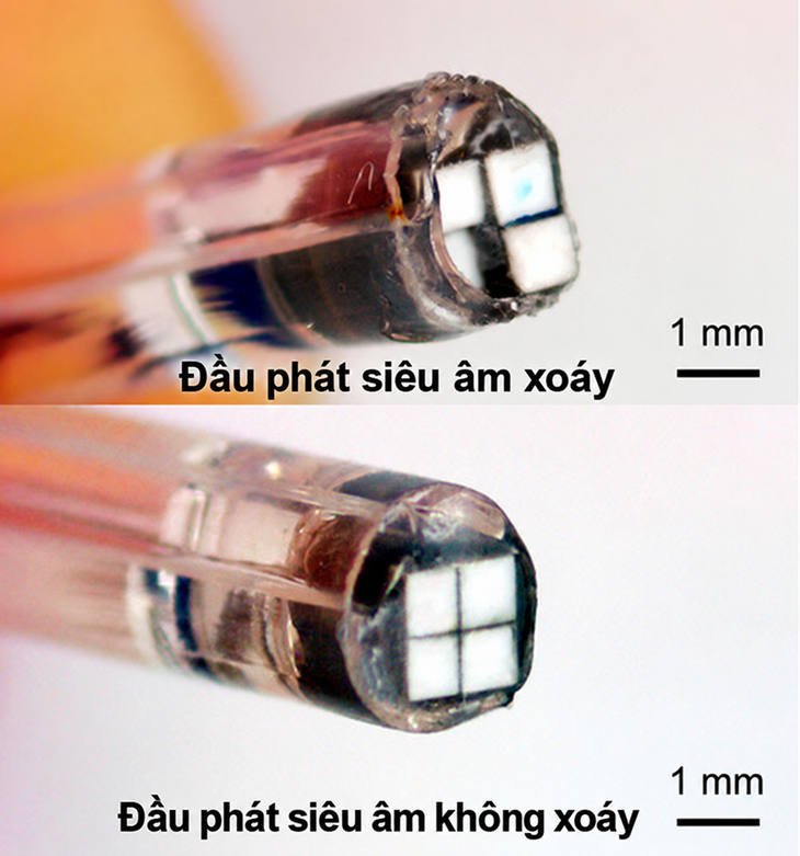 Dùng 'lốc siêu âm' khơi thông cục máu đông gần 8 cm trong 8 phút - Ảnh 1.