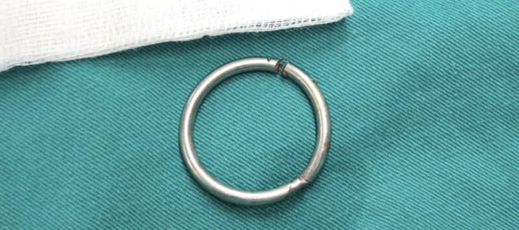 Suýt hoại tử tinh hoàn vì tự đeo vòng kim loại 3cm siết chặt vùng bìu suốt 10 ngày - Ảnh 2.