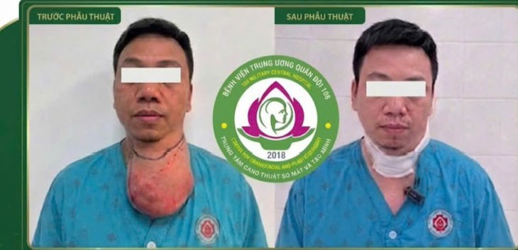Lấy khối u khổng lồ ở cổ, làm sao bảo tồn mạch máu và dây thần kinh? - Ảnh 2.