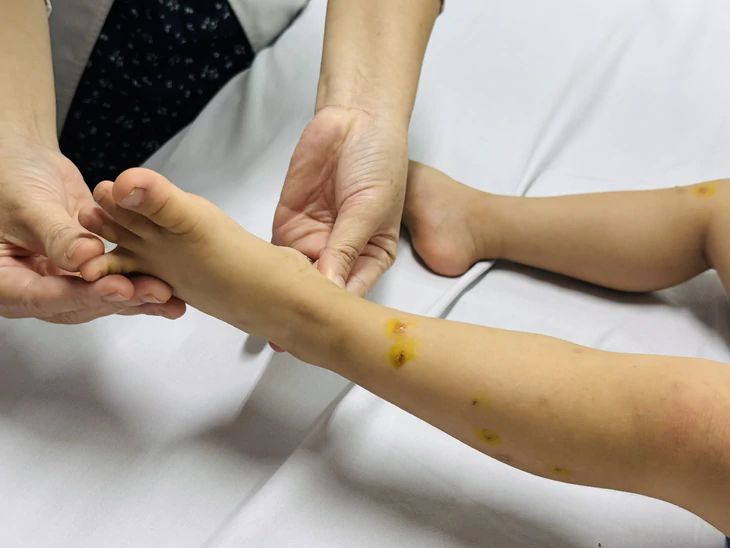 TP.HCM ghi nhận hơn 44.000 ca tay chân miệng, nhiều ca dương tính EV71 gây bệnh nặng - Ảnh 1.