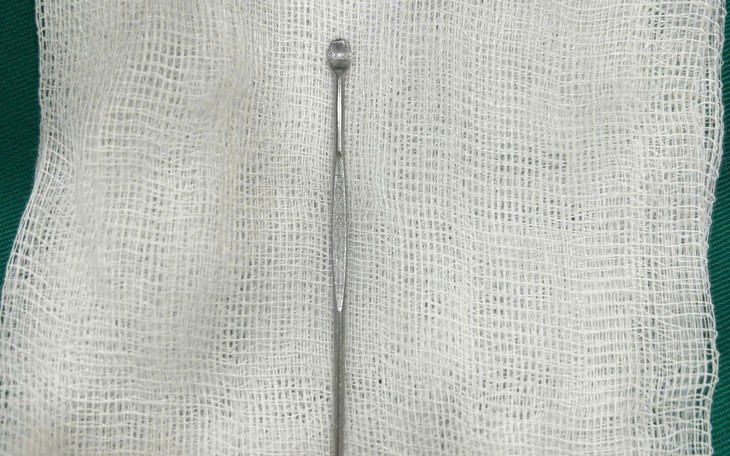 Cấp cứu bệnh nhân bị móc treo cán cọ toilet mắc kẹt sâu 15cm trong trực tràng - Ảnh 2.