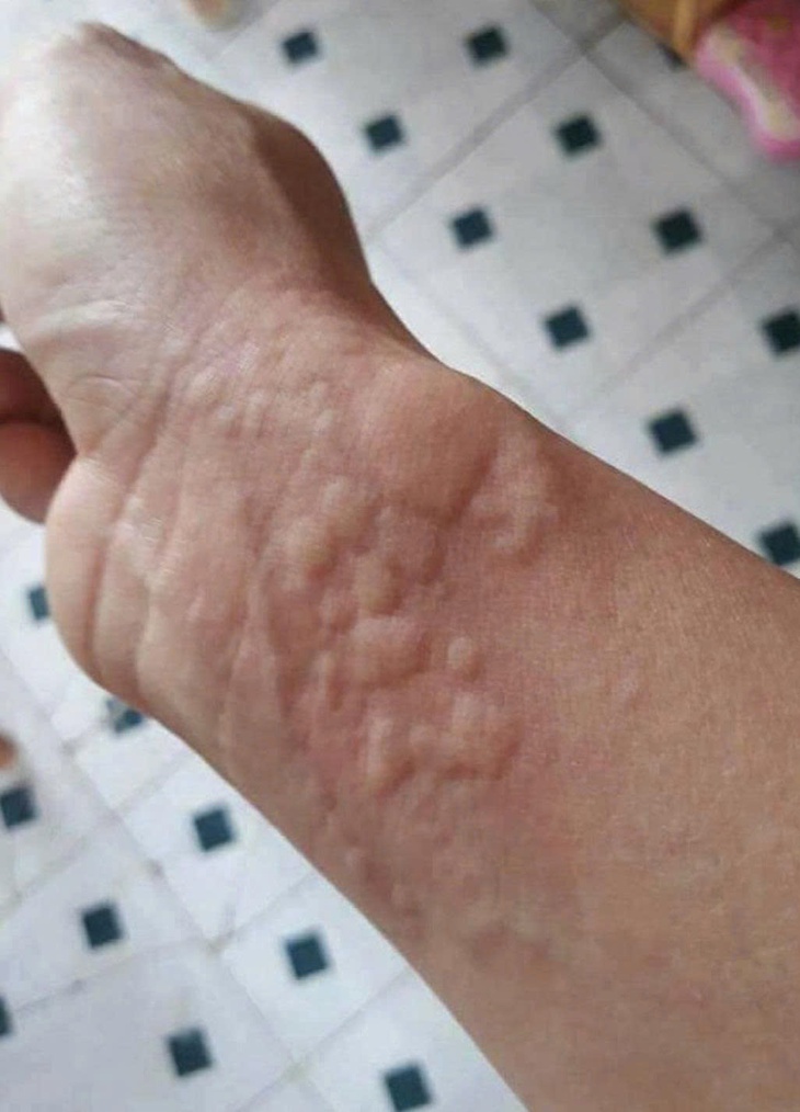 dị ứng - Ảnh 2.