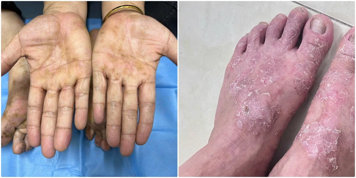 viêm da cơ địa - Ảnh 1.