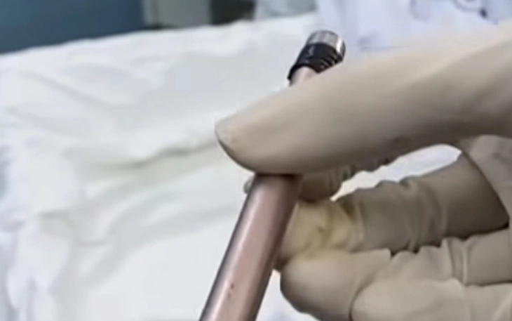 Bệnh viện Sản - Nhi Quảng Ngãi liên tiếp xử trí ca trẻ nuốt dị vật, có trẻ nuốt cả đồng xu - Ảnh 4.