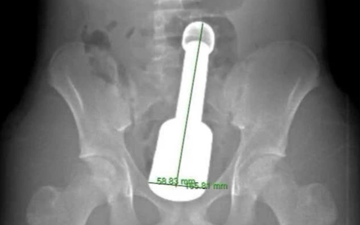 Bệnh nhi nuốt cả chìa khóa vào dạ dày, bác sĩ phải gây mê gắp ra ngoài - Ảnh 2.