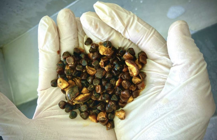 sỏi mật - Ảnh 1.