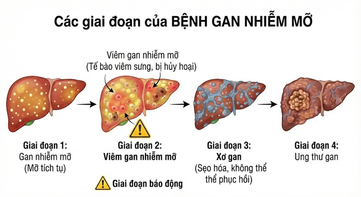 gan nhiễm mỡ - Ảnh 1.