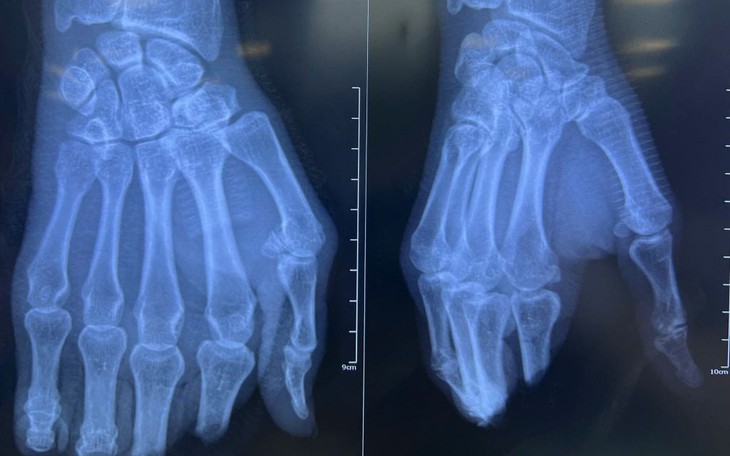 Nối thành công bàn chân đứt lìa do bị mát cắt cỏ chém - Ảnh 4.