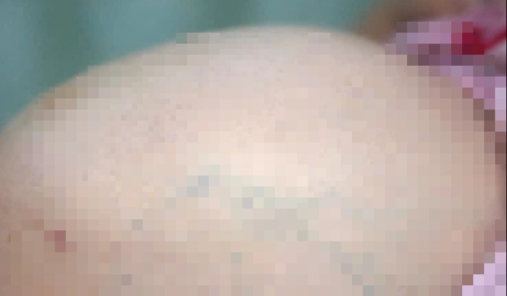 u xơ tử cung - Ảnh 2.