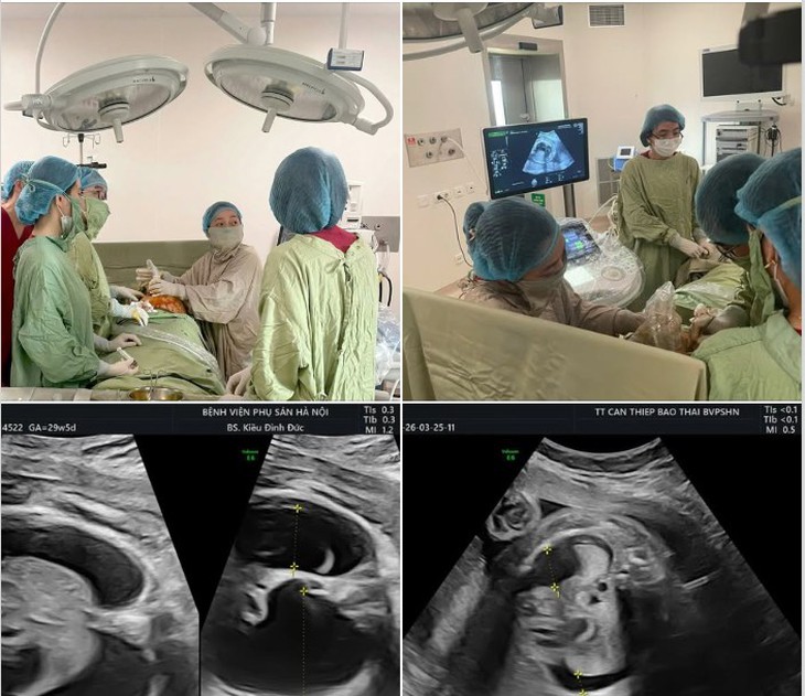 Can thiệp bào thai, cứu sống thai nhi bị tràn dịch phổi từ trong bụng mẹ - Ảnh 1. tràn dịch màng phổi - Ảnh 1.