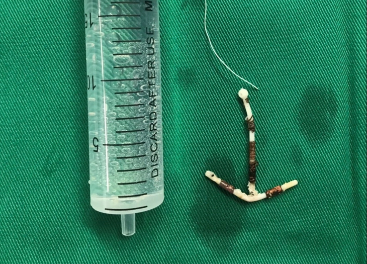 Lấy vòng tránh thai lạc chỗ suốt ¼ thế kỷ - Ảnh 1. tránh thai - Ảnh 1.