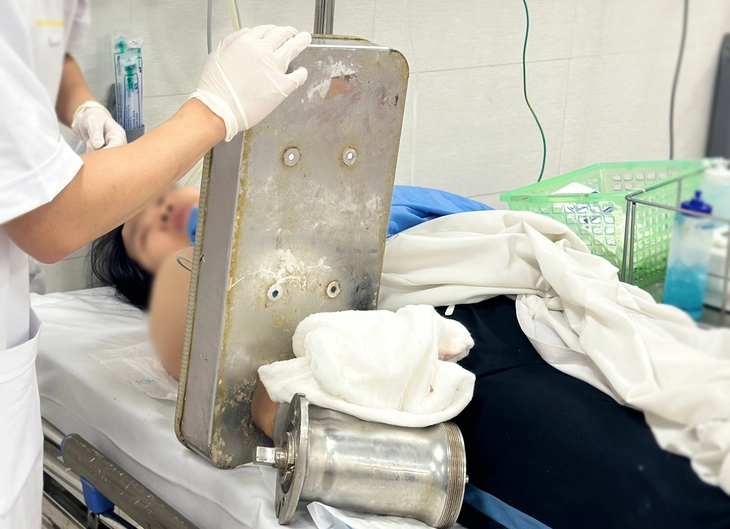 Kẹt nguyên bàn tay trong máy xay thịt, người phụ nữ phải phẫu thuật cắt cụt chi - Ảnh 1. máy xay thịt - Ảnh 1.