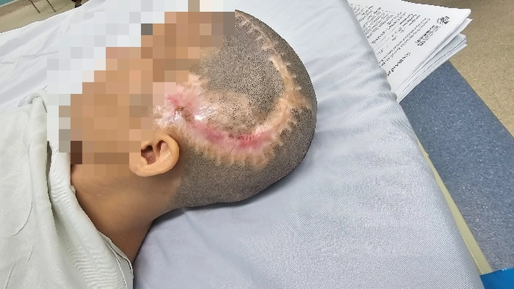 Cô gái 33 tuổi đột quỵ sau khi bơm mỡ tự thân vào vùng thái dương làm đẹp - Ảnh 1.