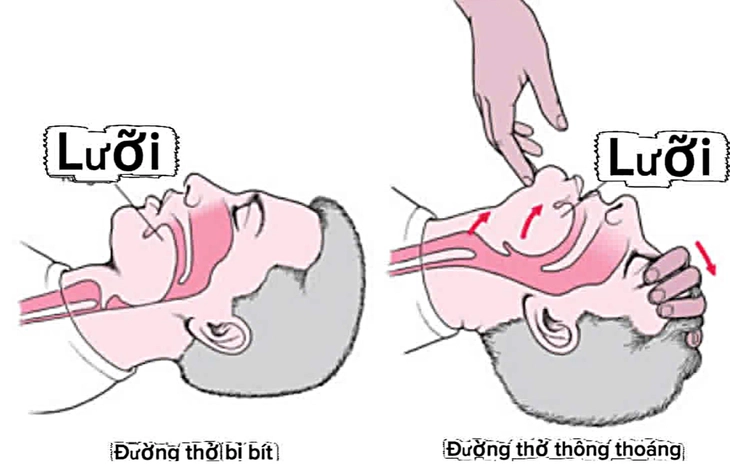 Đừng kéo lưỡi khi cấp cứu 'nuốt lưỡi' - Ảnh 1. nuốt lưỡi - Ảnh 1.
