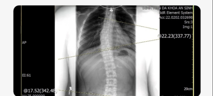vẹo cột sống - Ảnh 2.
