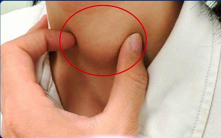Có nhân tuyến giáp là  phải kiêng iod, đậu phụ, đậu nành, cải bắp, súp lơ? - Ảnh 3.