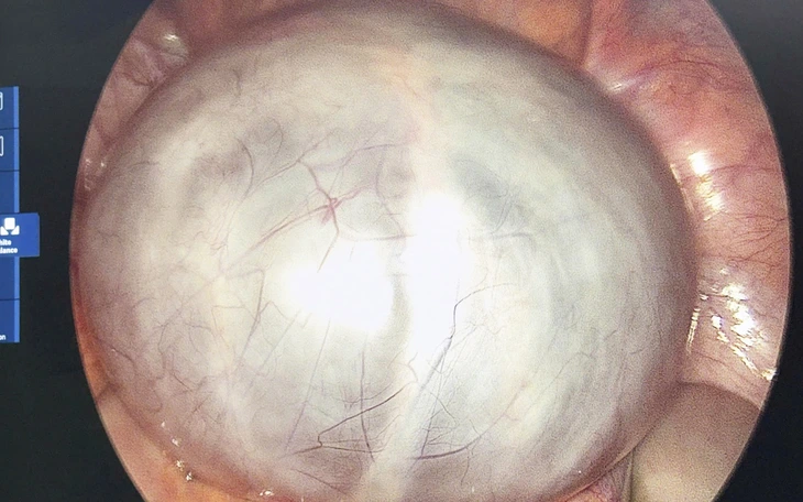 Phẫu thuật lấy khối u lớn vùng sau cổ suốt hơn 40 năm cho cụ ông - Ảnh 2.