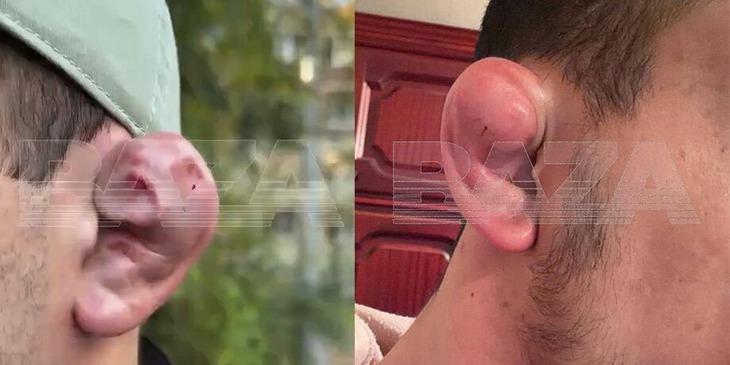 Thực hiện tạo hình 'tai súp lơ' để giống võ sĩ MMA - Ảnh 2.