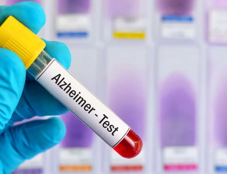 Alzheimer - Ảnh 1.
