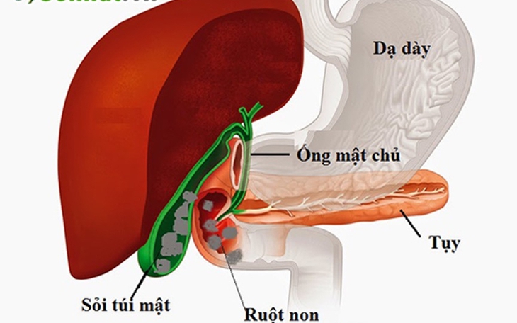 Nhịn ăn kéo dài, giảm cân nhanh có thể gây sỏi mật - Ảnh 1. sỏi mật - Ảnh 1.