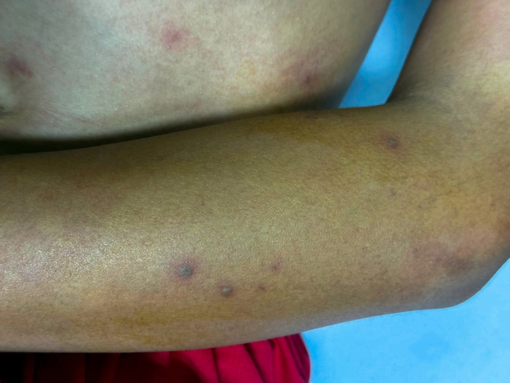 Bệnh viện Sản - Nhi Cà Mau cứu sống bé trai đi rừng bị ong vò vẽ đốt hơn 50 vết - Ảnh 1.