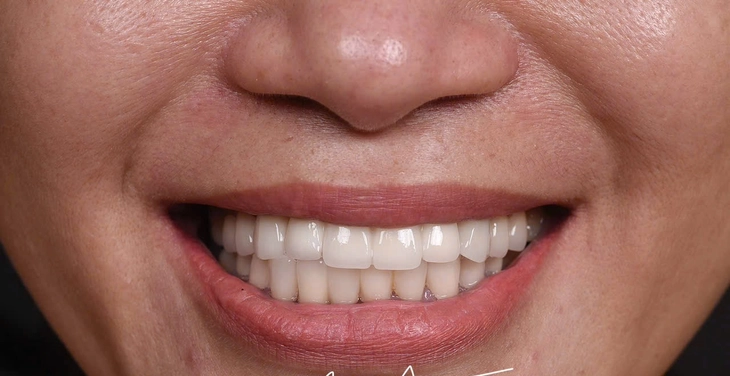 Làm thế nào để răng implant bền vững lâu dài? - Ảnh 1.