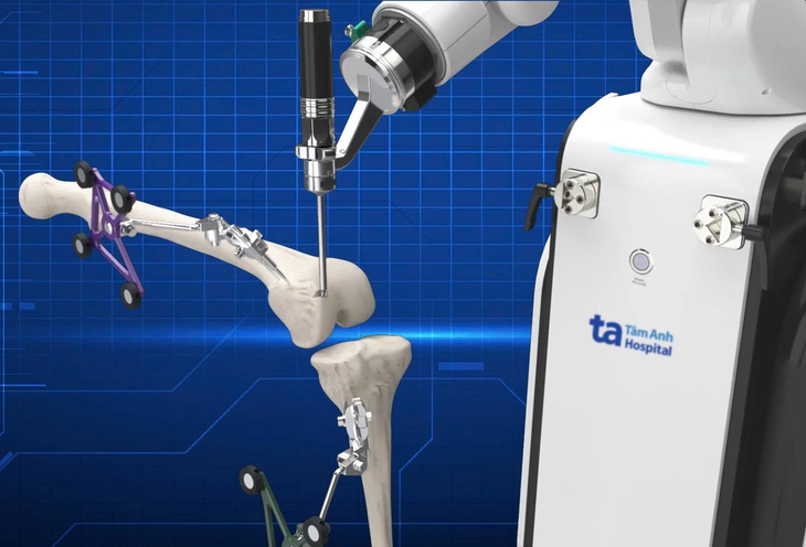 Bệnh viện Tâm Anh đạt 3 chứng nhận quốc tế với robot AI thay khớp - Ảnh 4.