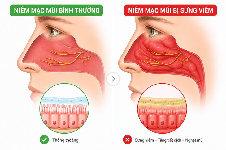Những lợi ích của nước muối ưu trương đối với các bệnh lý về mũi - Ảnh 2.