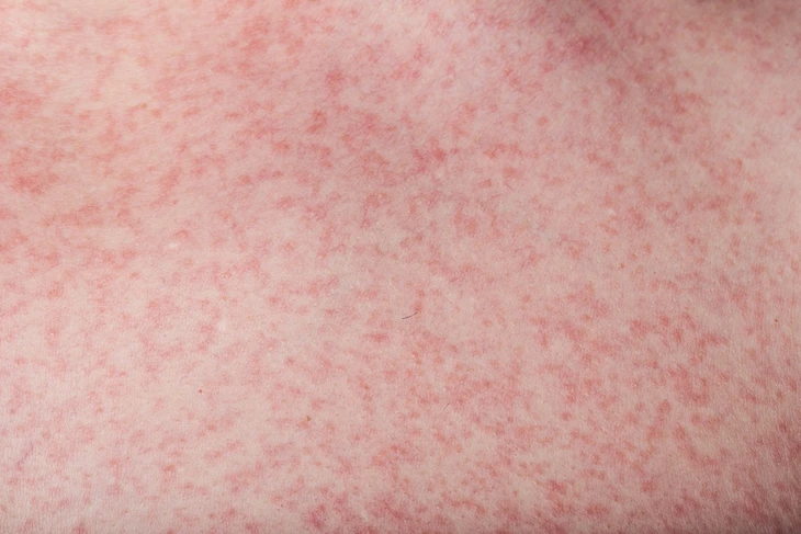 Chuyên gia cảnh báo về gánh nặng khó lường do sốt xuất huyết Dengue tại Đồng Nai - Ảnh 3.