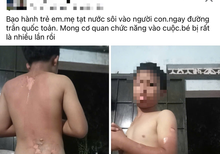 Xác minh thông tin mẹ tạt nước sôi lên người con trai ở Đắk Lắk - Ảnh 1.