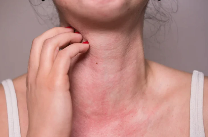Nghỉ lễ 2-9: Bỏ túi ‘bí kíp’ ngừa dị ứng khi lên rừng, xuống biển - Ảnh 2.