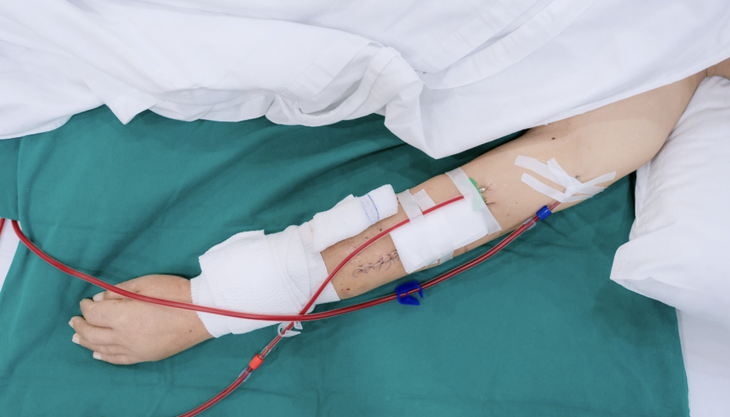Cứu cánh tay biến dạng cho bệnh nhân 11 năm chạy thận nhân tạo - Ảnh 2.