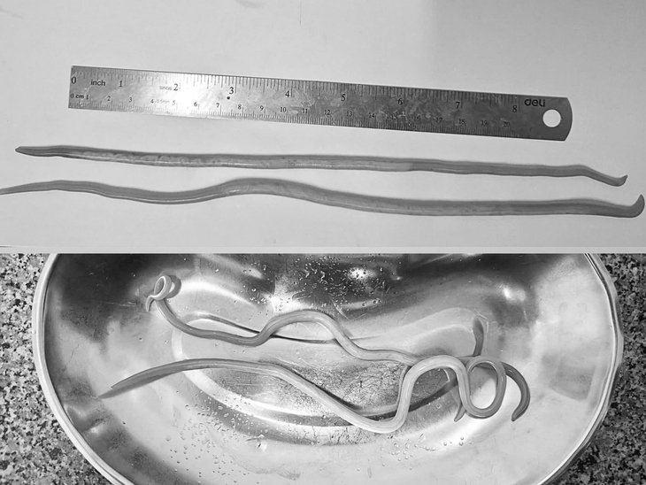 Bác sĩ Quảng Trị gắp 2 con giun đũa dài hơn 30cm chui vào đường mật bệnh nhi 12 tuổi - Ảnh 1.
