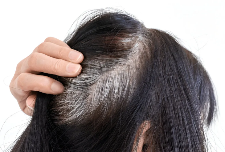 Hiện tượng tóc bạc ở trẻ em có đáng lo âu? - Ảnh 1.
