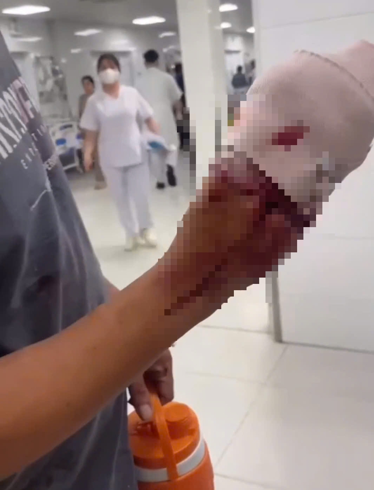 Hỗ trợ đưa nạn nhân đứt lìa 4 ngón tay đi cấp cứu - Ảnh 1.