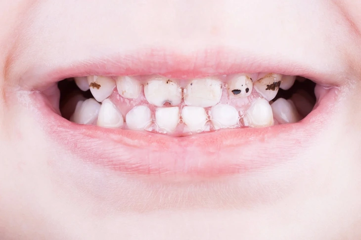 Tìm thấy cách chặn sâu răng bằng dung dịch đặc biệt, không cần khoan - Ảnh 2.