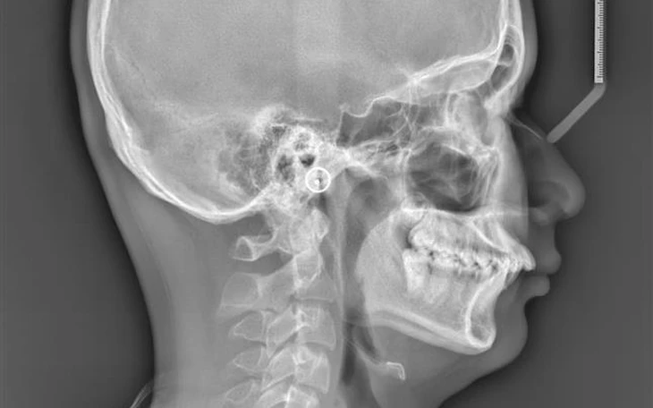 Ngưng thở khi ngủ do tắc nghẽn: Hiểu đúng về căn bệnh âm thầm - Ảnh 3.